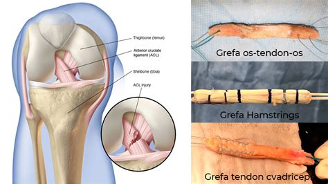 Ruptura de ligament încrucișat anterior Dr Vlad Predescu Chirurg