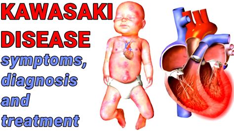 Kawasaki Disease Symptoms Diagnosis And Treatment YouTube