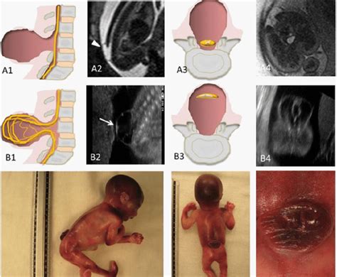 Myelomeningocele And Meningocele Schematic Representations A1 A3