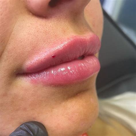 Lip Filler Dash Aesthetics Aberdeen