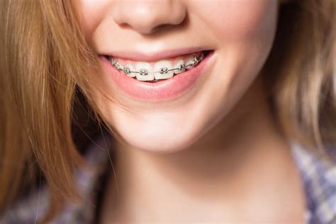 Warning Signs You Need Braces Immediately