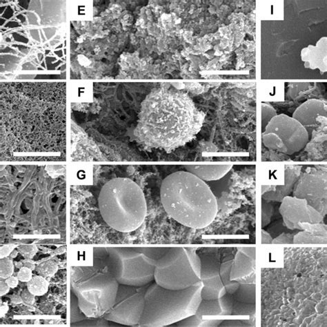 Components Of Clots Detected In Scanning Electron Micrographs A Download Scientific Diagram