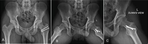 A AP B Frog Leg Lateral And C Dunn Lateral View At 4 Years