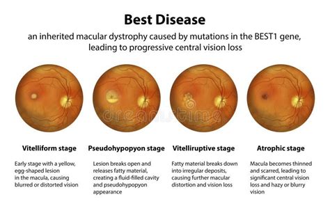 Stages Of Best Vitelliform Macular Dystrophy Illustration Stock Illustration Illustration Of