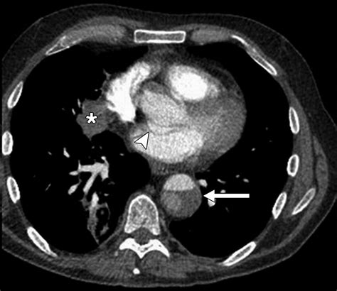 High Pitch Ecg Synchronized Pulmonary Ct Angiography Versus Standard Ct