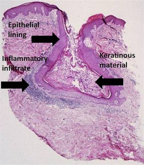 Acne Vulgaris Comedone Cx7 Source Graham Library Of Digital Download Scientific Diagram