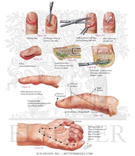 Abdominal Surgical Incisions Types