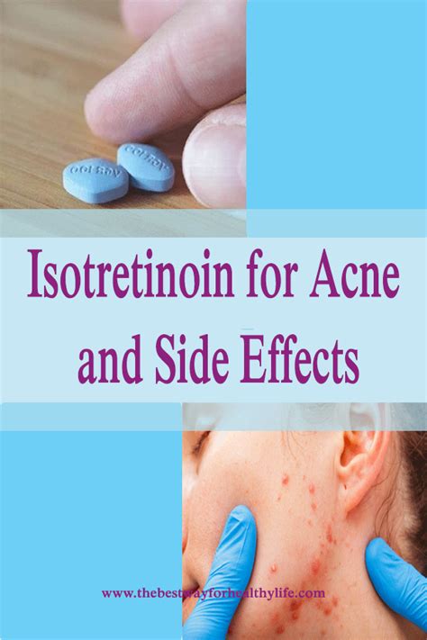 Isotretinoin for Acne and Side Effects - Healthy Beauty