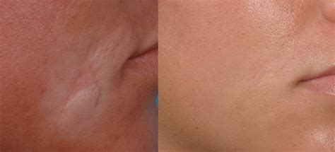 Scar Rejuvenation Denver Centennial Dtc Laser Aesthetics Of Colorado