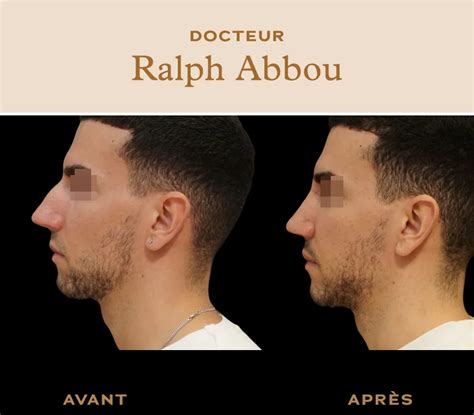 Rhinoplastie Avant Apr S Paris Dr Abbou Chirurgie Esthetique