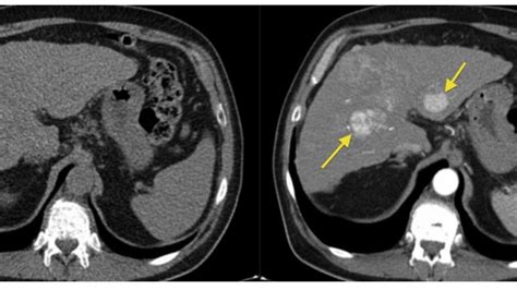 Ct Of Abdomen Without Contrast