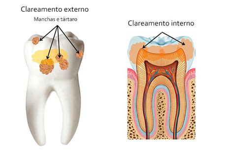 Clareamento Dental Clínica Leger Porto Alegre