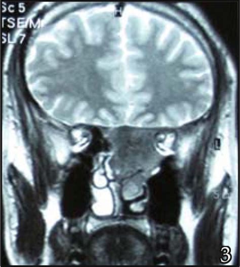 Endoscopic Management In Fibrous Dysplasia Of Ethmoid Sinus One Case