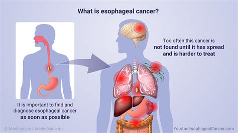 Slide Show Treating And Managing Esophageal Cancer