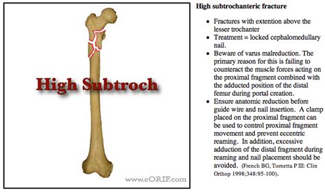 Subtrochanteric Femur Fracture S7223xa 82022 Eorif