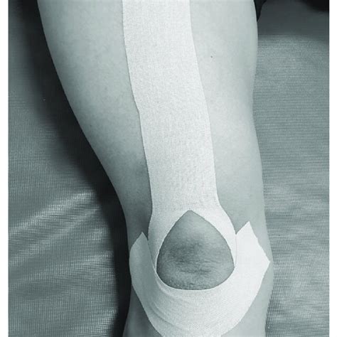 Kinesio Taping Technique Download Scientific Diagram