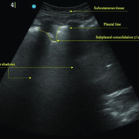 Subpleural consolidation | Download Scientific Diagram