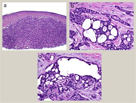 Sweat Gland Carcinomas With Nodular And Basaloid Differentiation