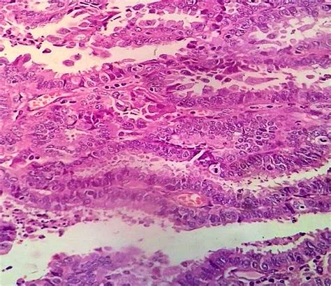 Synchronous Primary Endometrium And Ovarian Carcinoma A Case Report