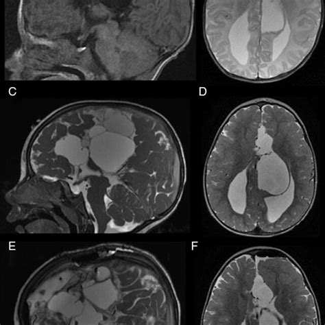 A T1 Weighted Sagittal And B Axial T2 Weighted Axial Mri At Day 37