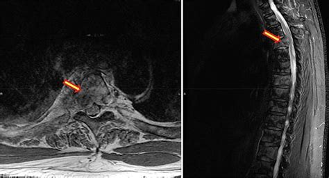 Mri Of The Cervical And Thoracic Spine Showing A Paraspinal Mass On The Download Scientific