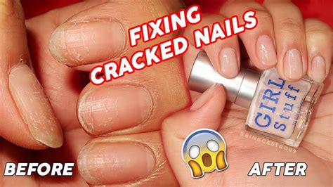 How To Treat Cracked Splitting Brittle Nails Bing Castro Youtube