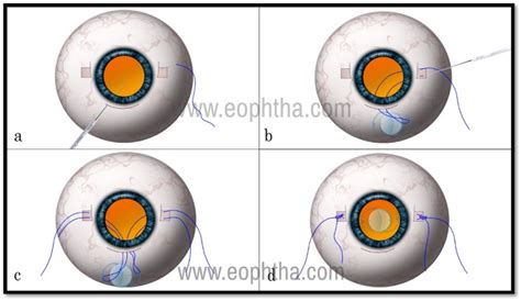 Scleral Fixated Intraocular Lens Implantation A Comprehensive Review