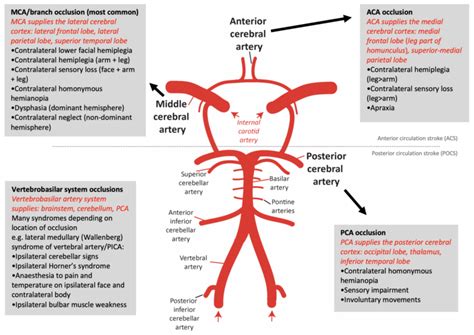 Stroke OSCEstop OSCE Learning