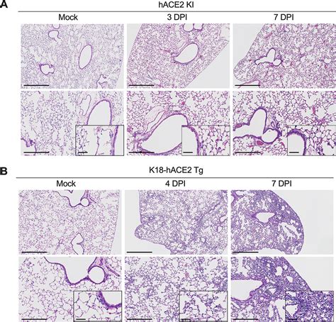 Sars Cov Causes Lung Infection Without Severe Disease In Human Ace