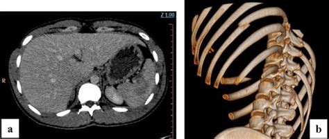 Mdct Of 25 Year Old Man With Grade Ii Splenic Injury A Axial Image