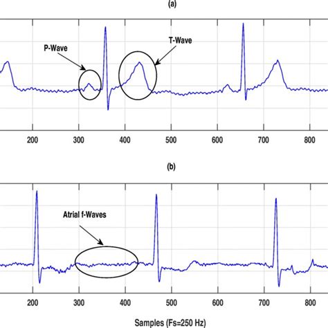 A Ecg Signal For Normal Heart Rhythm Or Hc B Ecg Signal For Af Case