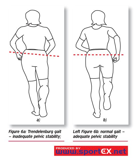 File:Trendelenburg gait.jpg - Physiopedia