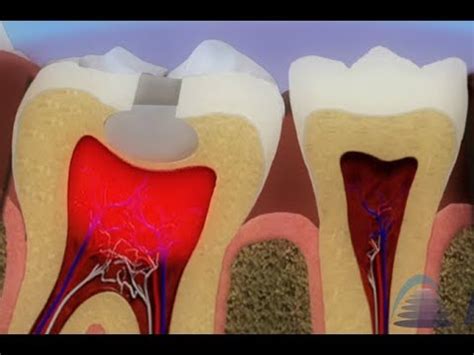 Pulpite cos è e come si cura StudioVirzi Dentista Milano