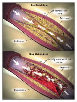 Drug Eluting Coronary Stents Promise And Uncertainty NEJM