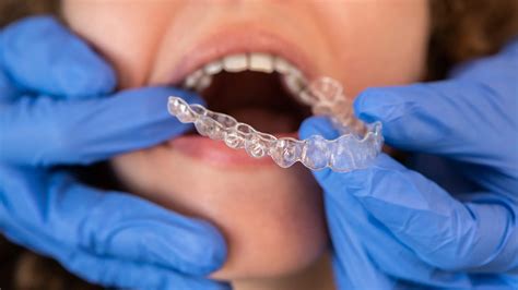 Invisalign Zahnschienen alles was du darüber wissen musst