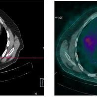 68Ga DOTATOC PET CT Scan A Computed Tomography CT And B Fused