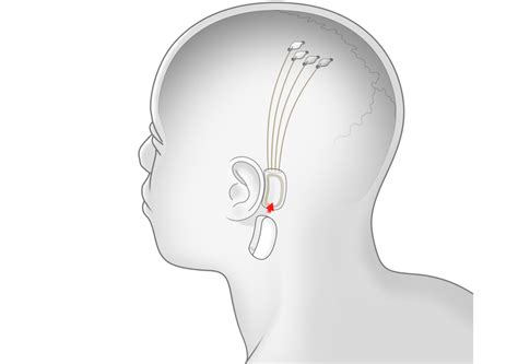 Neurolink Cria E Implanta O Primeiro Chip Cerebral Em Humanos Soul