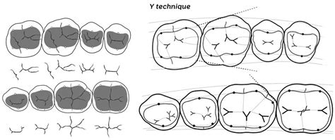 Dentistry Journal Free Full Text Resin Composites In Posterior