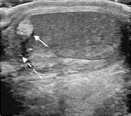 Torsion Of The Appendix Testis In A Year Old Boy Sagittal Gray Scale