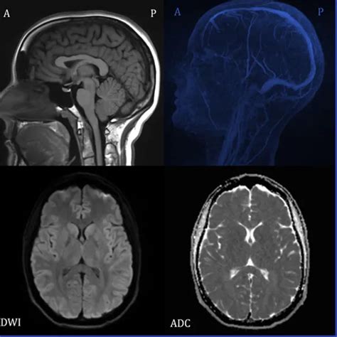 Mri Brain Epilepsy Protocol Scan Test Near You In Delhi Book Test At