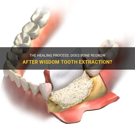 The Healing Process Does Bone Regrow After Wisdom Tooth Extraction