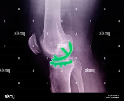 Knee X Ray Of A Year Old Man Showing A Partial Knee Replacement