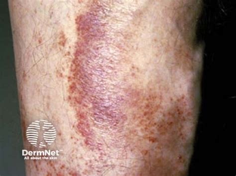 Purpura Causes Types And Images — Dermnet