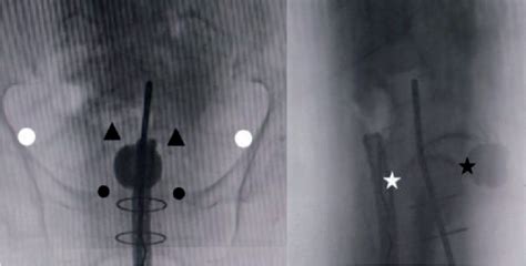 Figure 1 From Ultrasound Guided Brachytherapy For Cervical Cancer A Tool For Quality