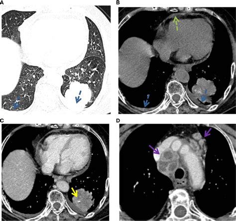 Frontiers Evaluation Of Ct Features For Differentiating Consolidation