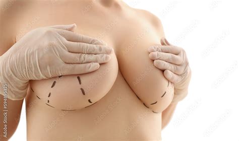 Foto De Woman Shows Surgical Recommendations Marked By Surgeon For