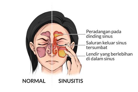 Gejala Sinusitis Harus Ditangani Segera