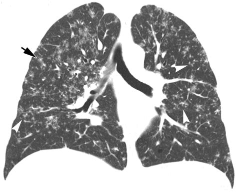 Imaging Of Pulmonary Viral Pneumonia Radiology