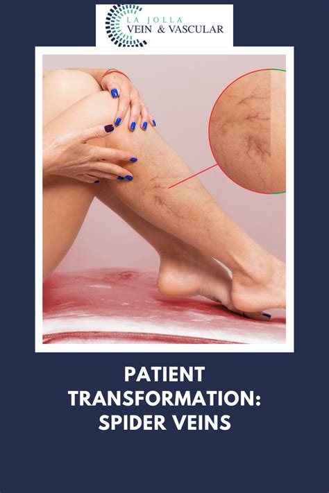 Spider Vein Treatment Before And After