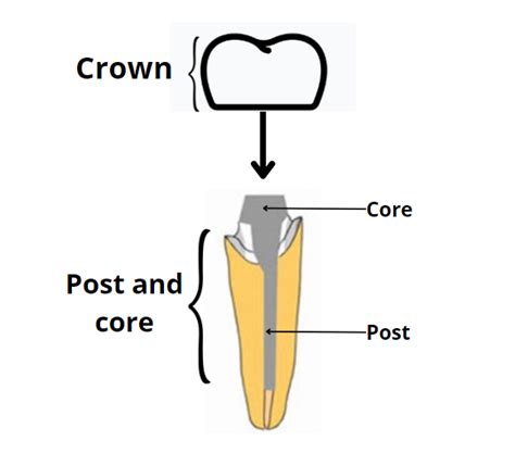 Do You Need A Post Crown For Your Tooth Pros Cons Types And More